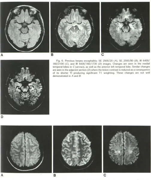 Fig. 7. Multiple regsclerosis: SE 2540/ 20 (A), SE 2540/ 80 (B), and IR 6040/ 160/ 2100 (C) images
