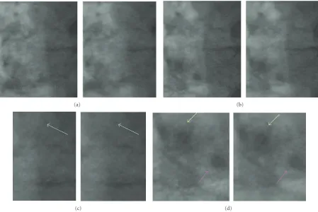Figure 12: (a) Two time instants of a ﬂuoroscopic sequence processed with the HR, (b) the ANMCR ﬁlter, (c), (d) one detail of eachimage is shown