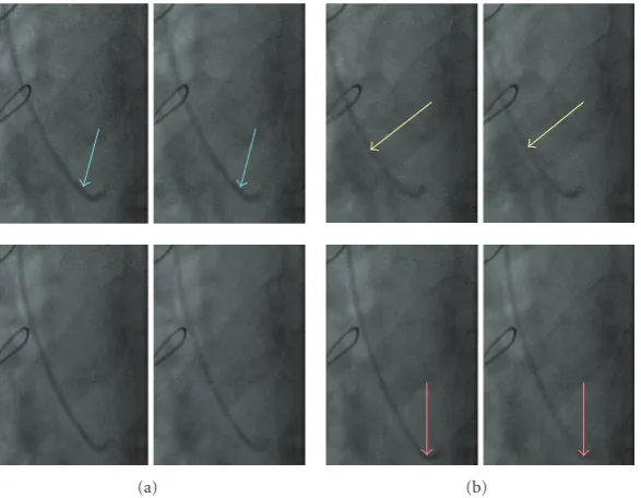 Figure 14: (a) Fluoroscopic sequence processed with the HR, and (b) the ANMCR ﬁlter. The two images on the right correspond to azoom on the region of interest of the two images of (a) .