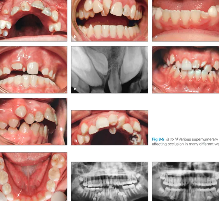 Fig 8-7 (a)  Parapremolar supernumerary teeth preventing eruption of mandibular premo- premo-lars