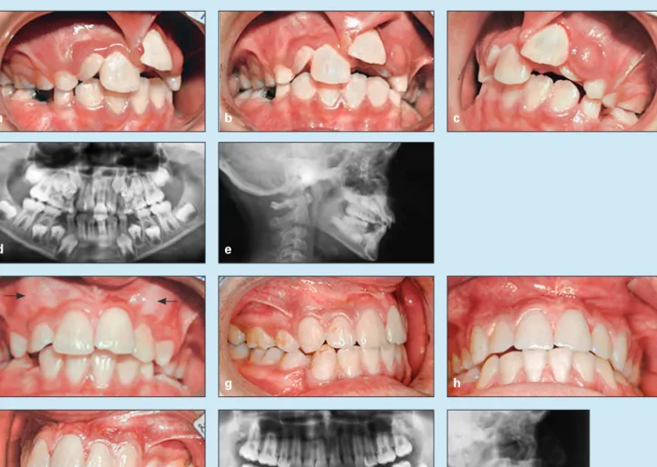 Fig 9-19  Treatment of a 10-year, 8-month-old girl with a Class II division 1 malocclusion and maxillary and mandibular protru- protru-sion