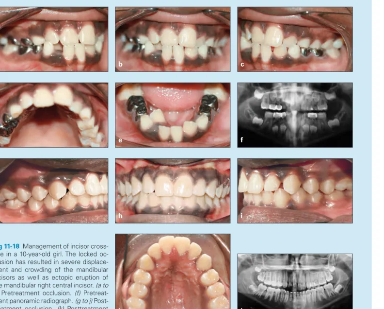 Fig 11-18  Management of incisor cross- cross-bite in a 10-year-old girl. The locked  oc-clusion has resulted in severe  displace-ment and crowding of the mandibular  incisors as well as ectopic eruption of  the mandibular right central incisor