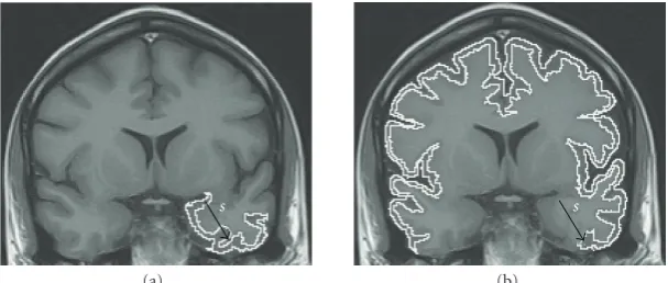 Figure 2: An MR-T1 image of the brain with one seed s inside the cortex. (a-b) The maximum inﬂuence zones of s within the cortex for fmaxwith δ3 and with δ6, respectively