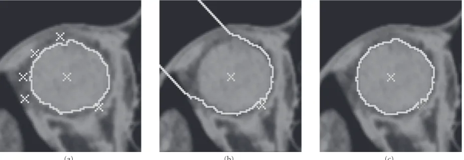 Figure 5: A CT image of the orbital region where the eye ball is obtained by seed competition