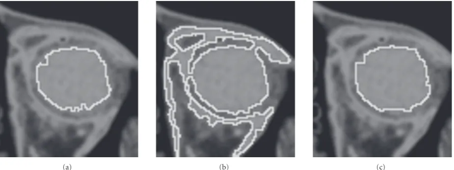Figure 6: A CT image of the orbital region with one seed inside the eye ball. (a) A wavefront of cost κ which represents the maximum extentof this seed inside the eye ball