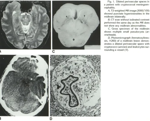 Fig. 1. a paDilated perivascular spaces in tient with cryptococcal meningoen-