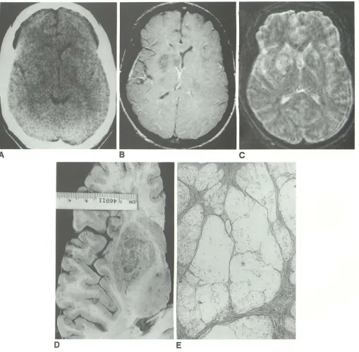 Fig. 2. Right basal ganglia cryptococcomas composed abnormaland right caudate nucleus