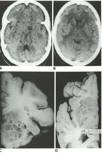 Fig. 3. CT patient cent demonstration of both lu-and isodense cryptococcomas in a with CNS cryptococcosis