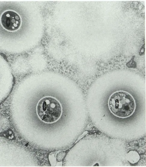 Fig. 5. (C). surrounding the microorganisms. (Courtesy Electron microscopy (X5300) shows three cryptococci Note the thick polysaccharide capsule (between arrowheads) of Dr Alo.) 