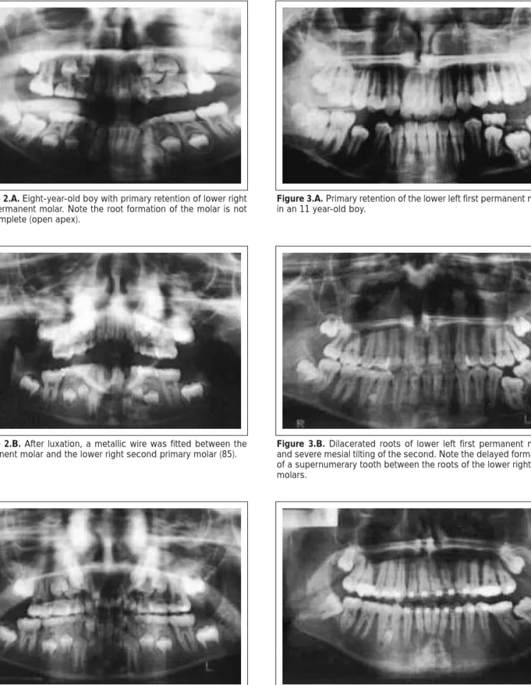Figure 3.A. Primary retention of the lower left first permanent molar in an 11 year-old boy.