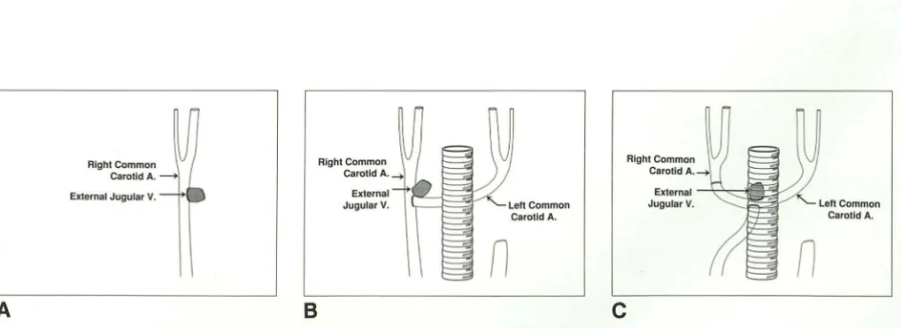 Fig. 1. Diagrams of three types of aneurysms studied. A, lateral; 8 , bifurcation; C, terminal