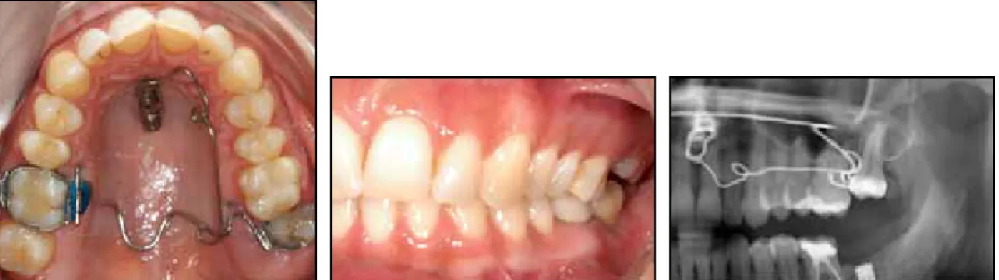 Fig. 9  Case  2. After two more months, upper left second molar intruded with noticeable overcorrection; 