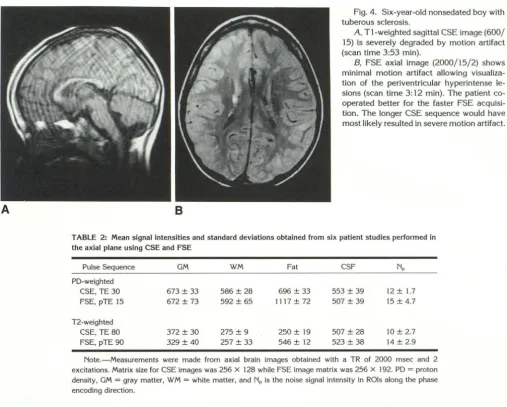 TABLE 3: Contrast-to-noise ratios of conventional spin-echo and Fast Spine-echo images as obtained from the data in Table 2 