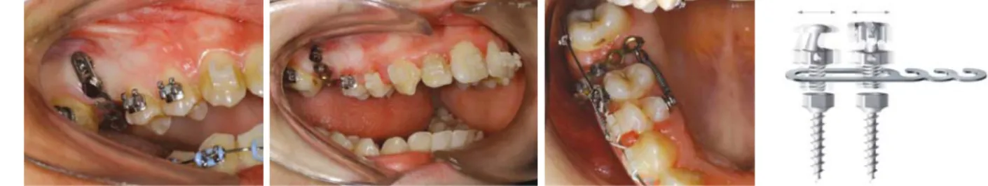 Fig. 5.  Clinical applications of non-invasive mini-plate using Joint Head type microimplants (Courtesy of Dr