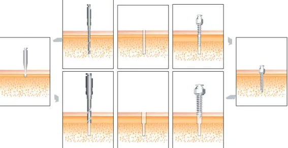 Fig. 8.  One-step (upper) and two-step (lower) self-drilling procedures. When the microimplant is inserted in a diagonal direction, it is better to make an indentation first in the cortical bone using a round bur (two-step protocol) to prevent slippage of 