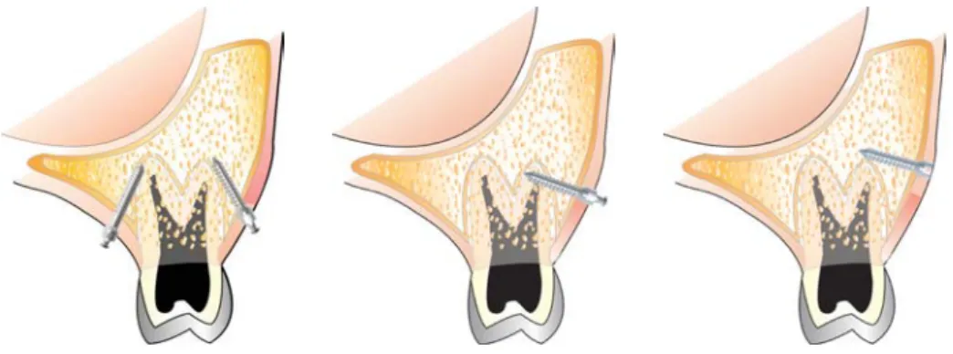 Fig. 9.  Diagonal (left) and perpendicular (middle &amp; right) insertion of microimplants.