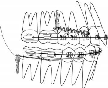 FIGURE 1. A distalizing force was applied to a canine by a NiTi coil spring connected from a maxillary microscrew implant, which was placed into alveolar bone between a second premolar and a first molar