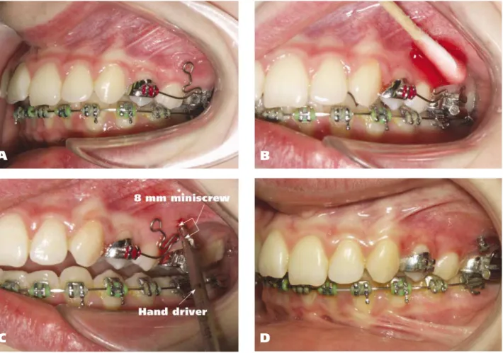 Figure 1. A. Surgical guide marks the site of temporary anchorage device (TAD) insertion on a periapical radiograph