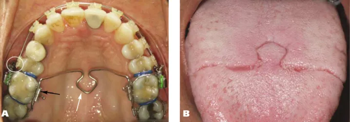 Figure 4. Molar intrusion with a single temporary anchorage device (TAD) and a transpalatal bar