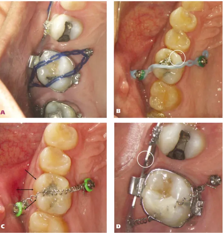 Figure 5. Molar intrusion with two temporary anchorage devices (TADs). The buccal TAD was placed between the first and second molar, and the palatal TAD was placed between the second premolar and the first molar