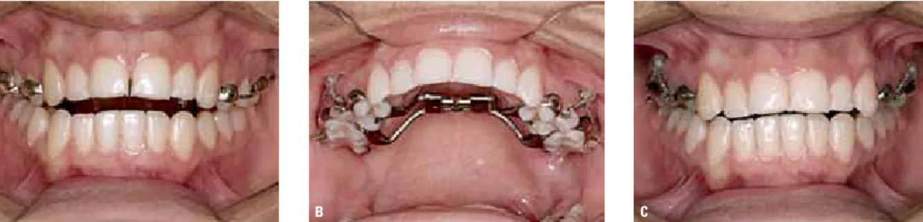 FiGUre 11 - intrusion of posterior teeth using mini-implants via the buccal region only