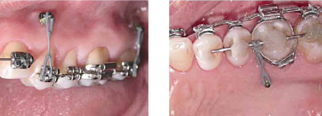 FiGUre 13 - intrusion of four posterior teeth using two mini-implants via the buccal region