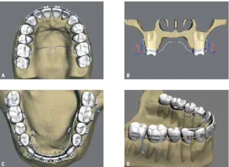 FiGUre 10 - intrusion of posterior teeth using mini-implants via the buccal region only