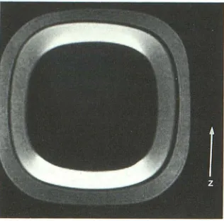 Fig. sphenoid marrow A, B, 6. Clinical example of fat-suppression failure in the clivus