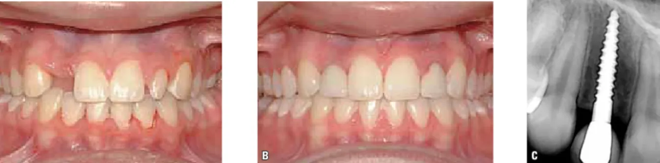 FIGURE 10 - Temporary lateral incisor replacement. A) Anterior at TAD placement. B) Anterior at 5 year retention