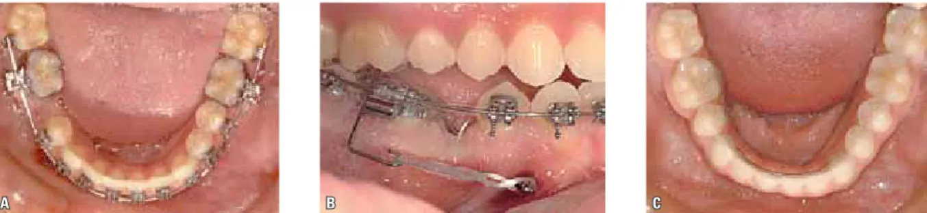 FIGURE 1 - Protraction of posterior teeth to eliminate the need for restoring congenitally missing teeth