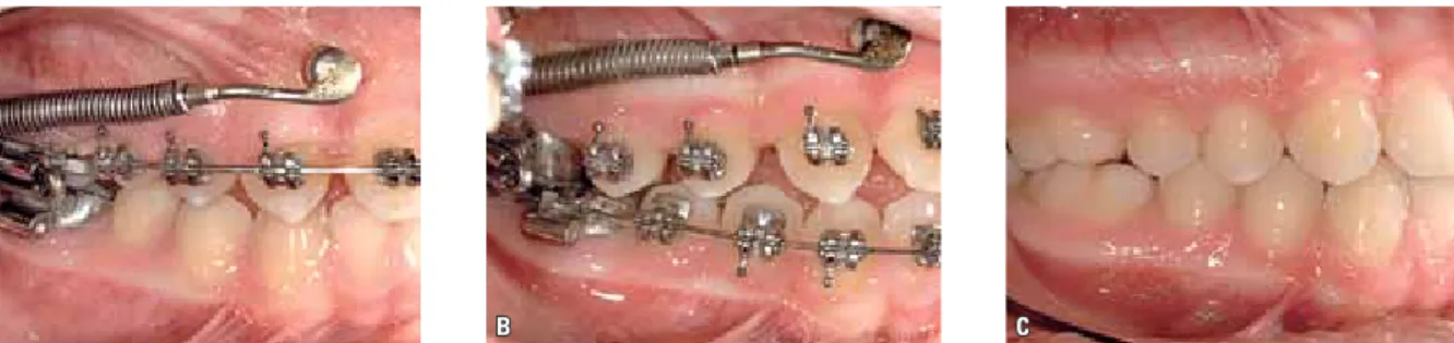FIGURE 2 - Distalization of maxillary teeth using TAD-Forsus combination. A) Buccal at TAD placement; B) Buccal after molar distalization; C) Buccal  at posttreatment.