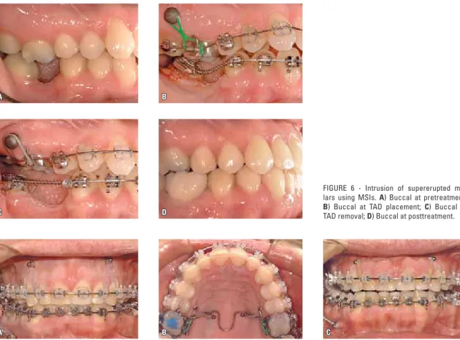 FIGURE  6  -  Intrusion  of  supererupted  mo- mo-lars  using  MSIs.  A)  Buccal  at  pretreatment; 