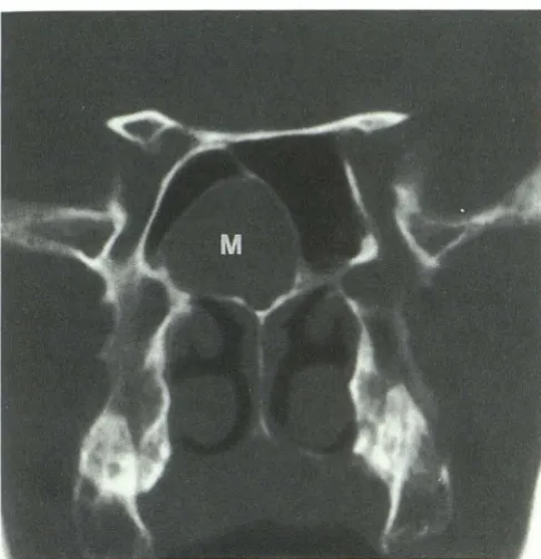 Fig. 7. Posterior image from pattern sphenoid sinus sphenoid sinus. Remainder SSCT demonstrating sporadic (pattern V) of inflammatory sinonasal disease