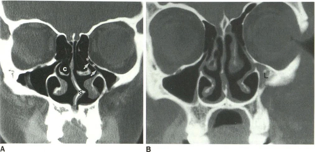 Fig. 9. A , inflammatory bilateral uncinate process sinus Nondiseased and B, diseased examples of hypoplastic maxillary sinuses (different patients)