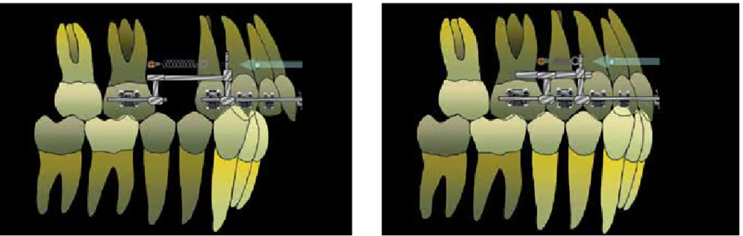 Figure 16 - Retraction of the upper anterior teeth when these are with ideal inclination.