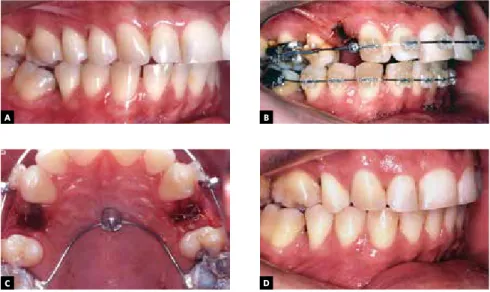 Figure 4 - Example of necessary torque for correction of upper incisors  inclination.