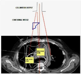 Figure 11.-A simple sketch of the dose distribution of a conformal wedge  for  a  lung  tumor  (Google  Images  with  paper  author's composition/design).