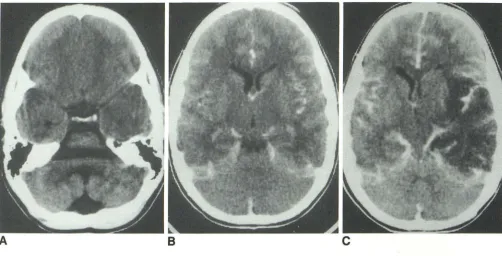 Fig. 19. Herpes encephalitis; 11-year-old boy A, with 1 day of headache and generalized seizure immediately before CT