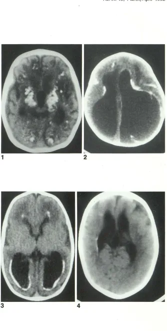 Fig. 1. Toxoplasmosis in a 1-month-old infant; noncontrast CT. There is extensive 