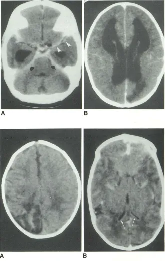 Fig. 8. Neonatal metococcal meinfaA, ningitis; 5-week-old nt with 1 week history of group B strep-ningitis