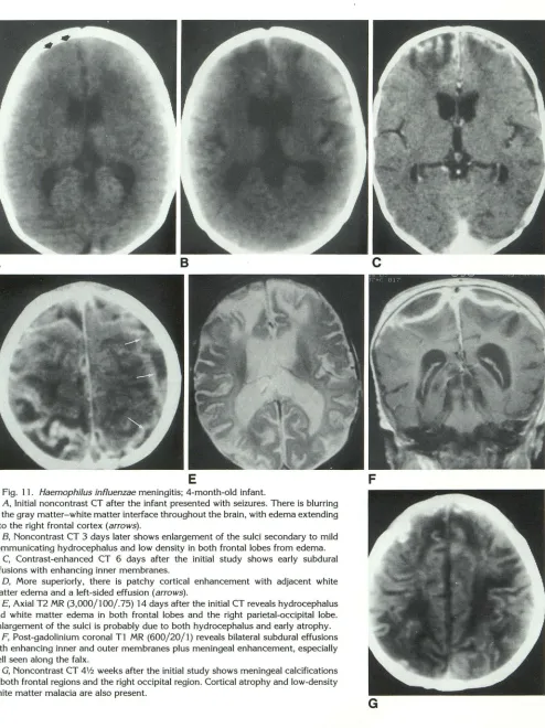 Fig. 11. Haemophi/us influenzae the gray A, meningitis; 4-month-old infant. Initial noncontrast CT after the infant presented with seizures