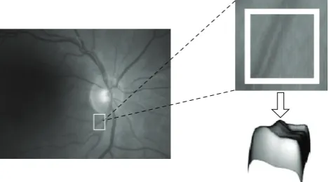 Figure 1: Representation of a region in the image as a landscape.Left side shows the retinal image with the region of interest markedwith a white rectangle