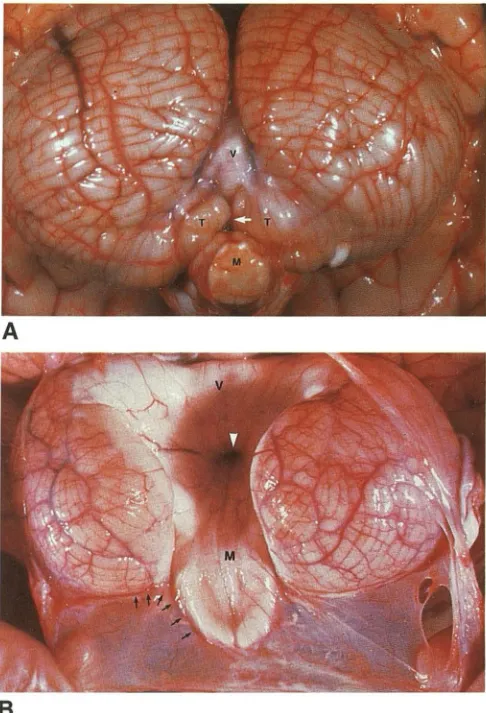 Fig. form9. Comparison of normal brain and Dandy-Walker mal-ation. A, Normal unfixed cerebellum viewed from behind and below 