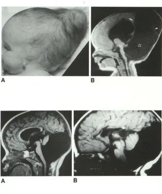 Fig. 11. Dandy-monthWalker malformation, 1 -old girl. 