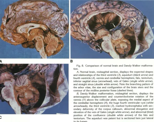 Fig. 8. Comparison of normal brain and Dandy-Walker malforma-tion. 