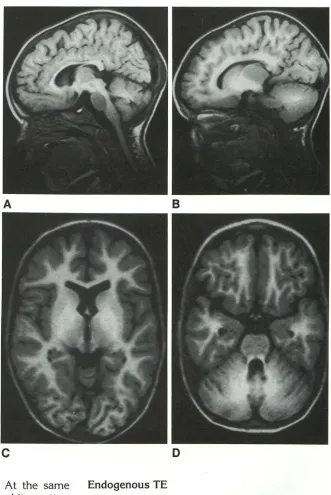 Fig. 13. Hepatic encephalopathy; basal ganglia. The changes are nounced in the globus pallidus