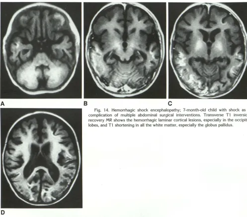 Fig. 14. Hec omplication morrhagic shock encephalopathy; 7-month-old child with shock as a of multiple abdominal surgical interventions