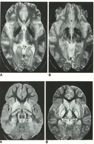 Fig. 1. Topistic area. (A) red nucleuin the pallidum, the substantia nigra, and the phology ages at the level tem, T2-weighted im-of the foramen of Monro and of the midbrain (B) show the mor-of parts of the extrapyramidal sys-as indicated by the deposition