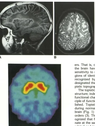 Fig. 4. Topistic to the distribution 18fluorodopa and illustrates the concept area. PET demonstrates the distribution of of a topistic area related of a particular neurotransmitter