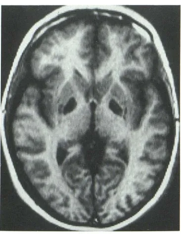 Fig. 5. Ecstasy encephalopathy. Selective involvement (3,4 changes required psychiatric hospitalization